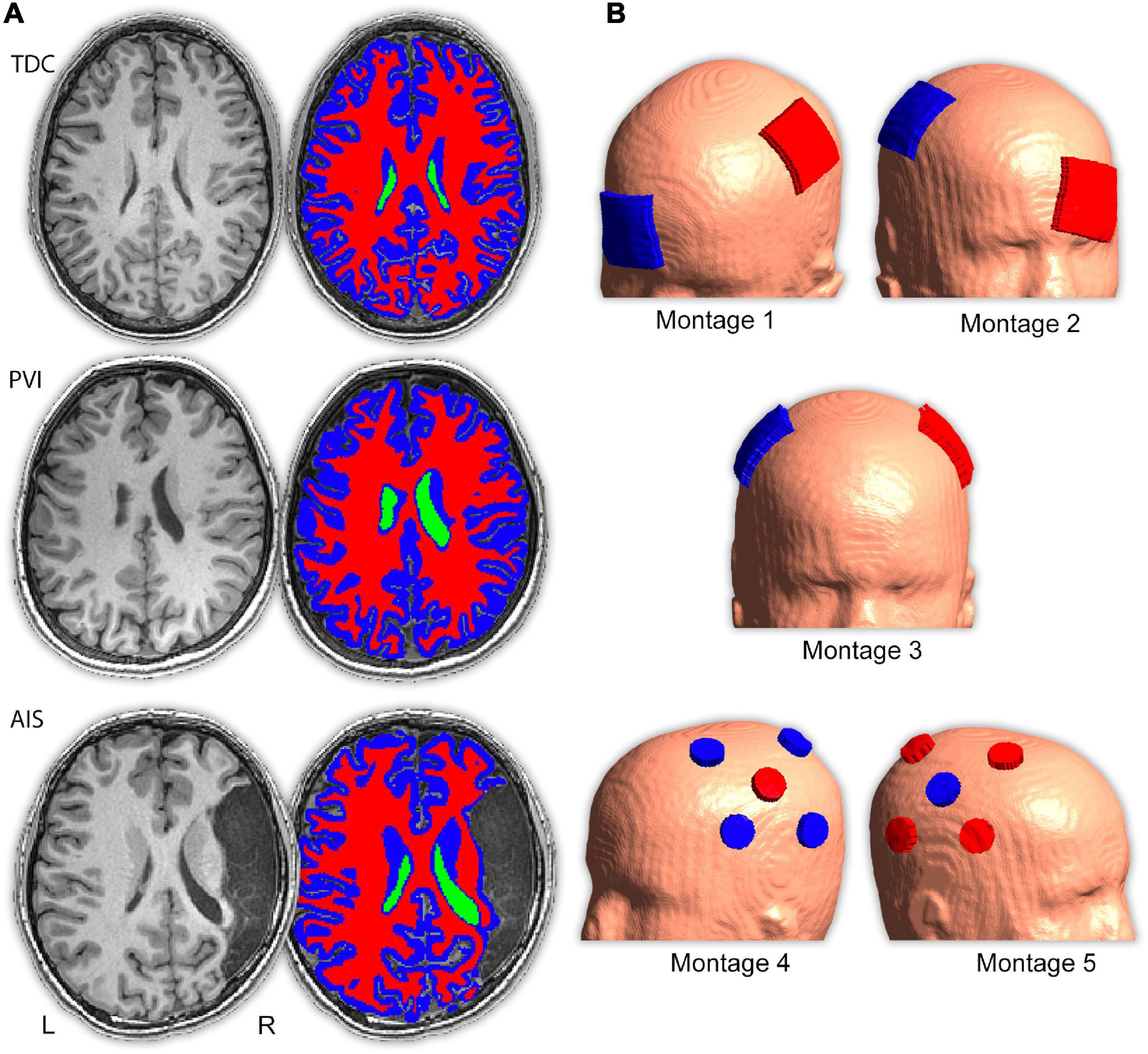 Electric field simulations of transcranial direct current stimulation in children with perinatal stroke